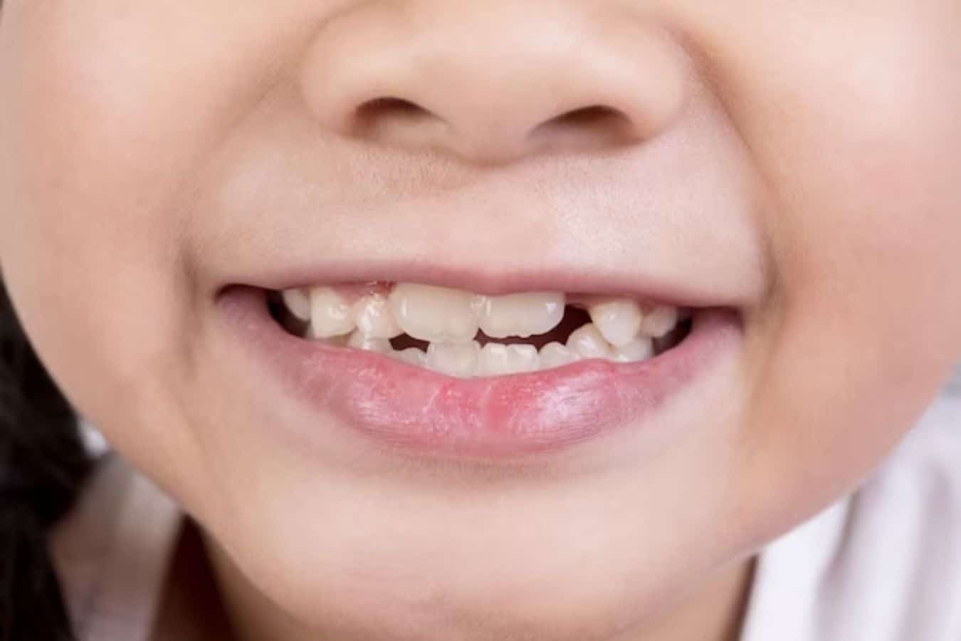 Crooked Teeth treatment in El paso