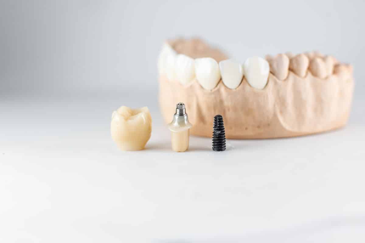 dental implant in El Paso