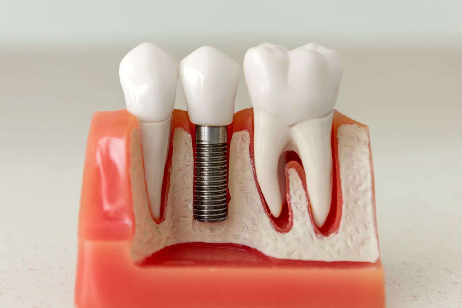 What Are the Different Types of Dental Implants (2) dental implants in El Paso