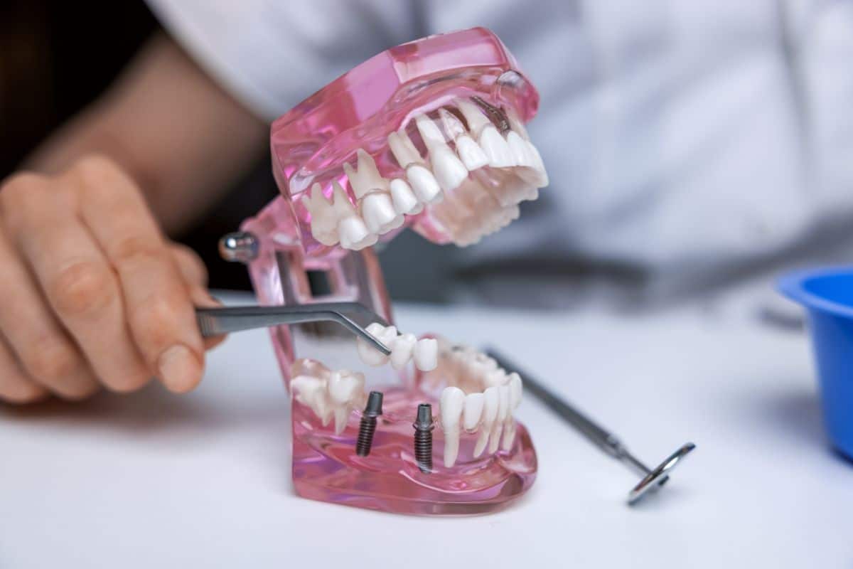 The Benefits of Dental Implants for Replacing Missing Teeth dental implants in El Paso