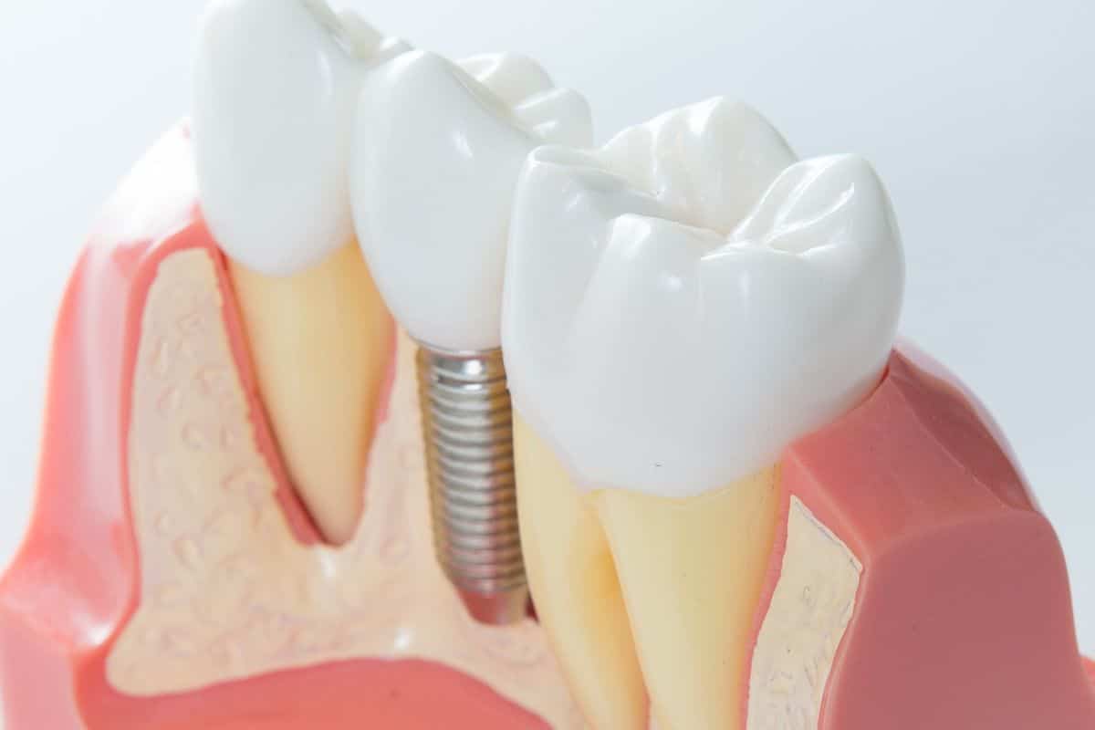 How Strong Are Dental Implants Dental implants