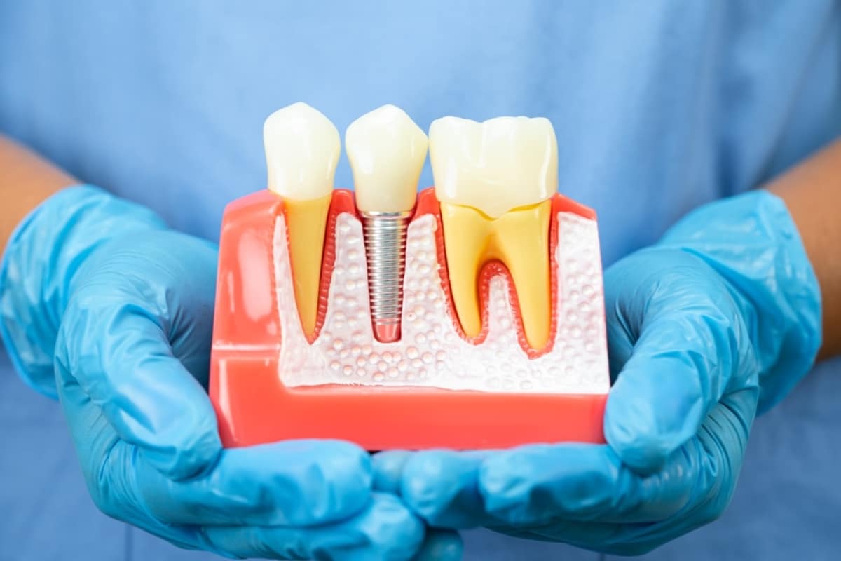 Implant Dentist EL Paso Implant Dentist EL Paso