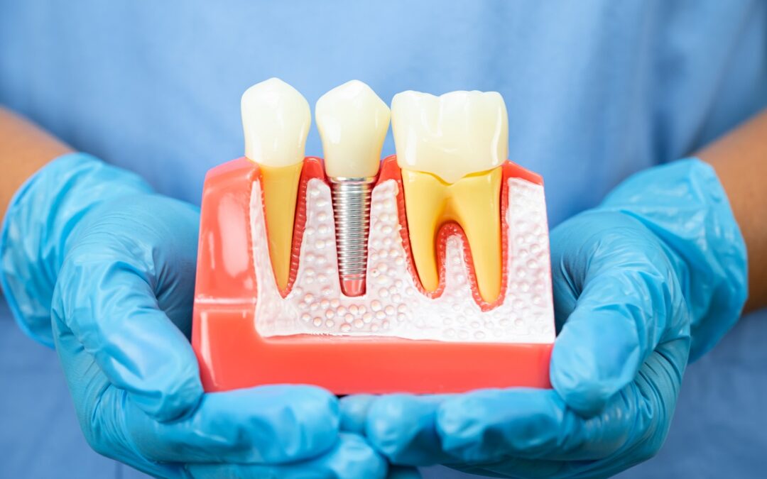 6 Everyday Habits That Can Damage Your Dental Implants (And How to Avoid Them)