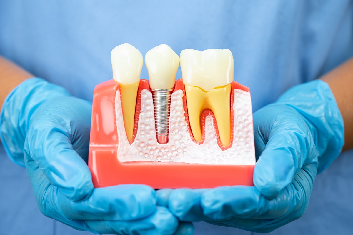 Everyday habits that can damage dental implants