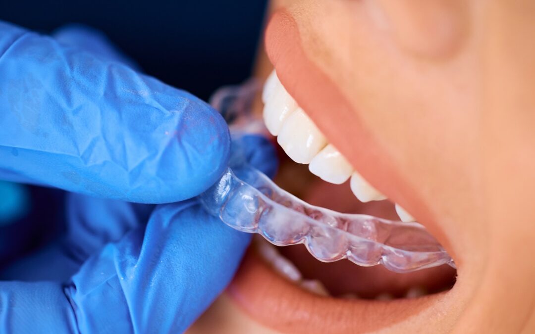 Is Tooth Reshaping After Invisalign Necessary or Just Cosmetic?