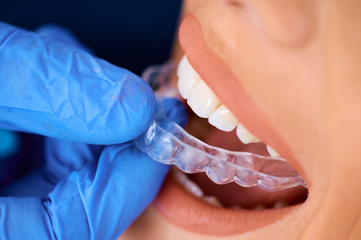 is tooth reshaping necessary after invisalign