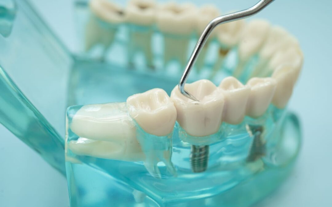 Stop a Missing Tooth Before It Costs You Thousands