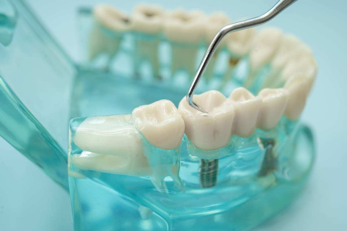 Dental Bridges in El Paso Dental implant model showing tooth replacement option with metal post and crown on transparent model.